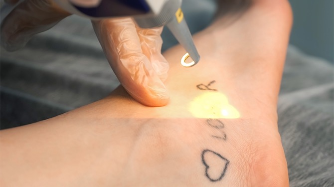 Vrouw heeft spijt van tattoo removal