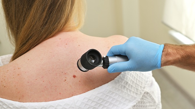 Moedervlek of melanoom? Doe hier niet de test en ga naar je dermatoloog