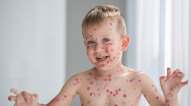 Thema kinderfeestje Jayden (8): Mazelen