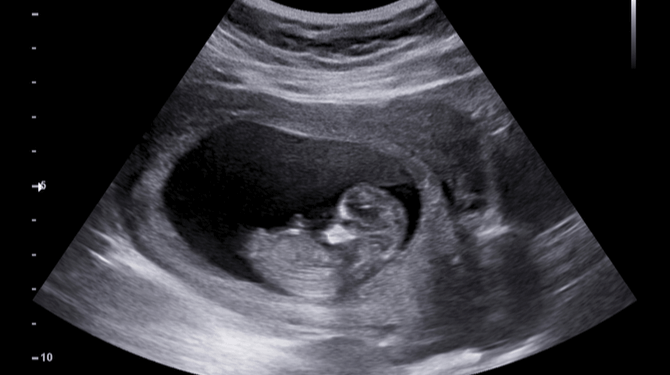 Foetus hoopt op twee vaders, maar wil het nog niet weten voor de bevalling